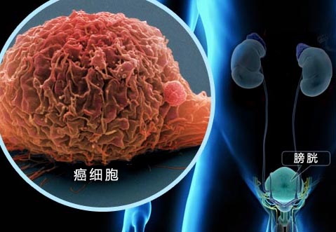 改善生存状况 老年膀胱癌也可考虑辅助化疗